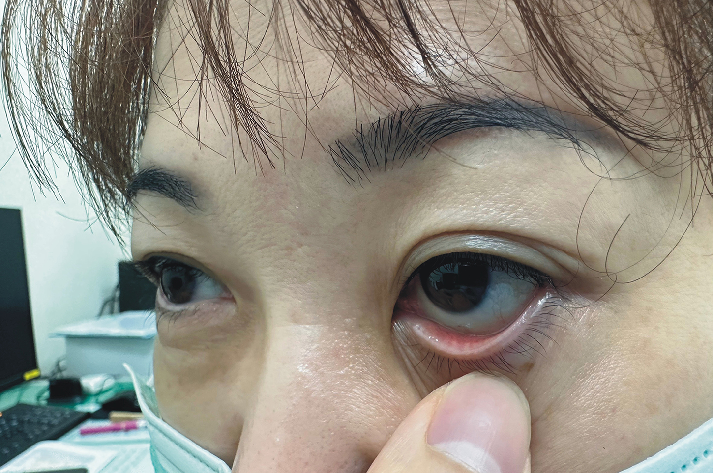女性患者噴霧器噴灑消毒劑時，不慎將藥水噴濺到自己眼睛，立刻感到劇痛難忍。(圖/彰基提供)
