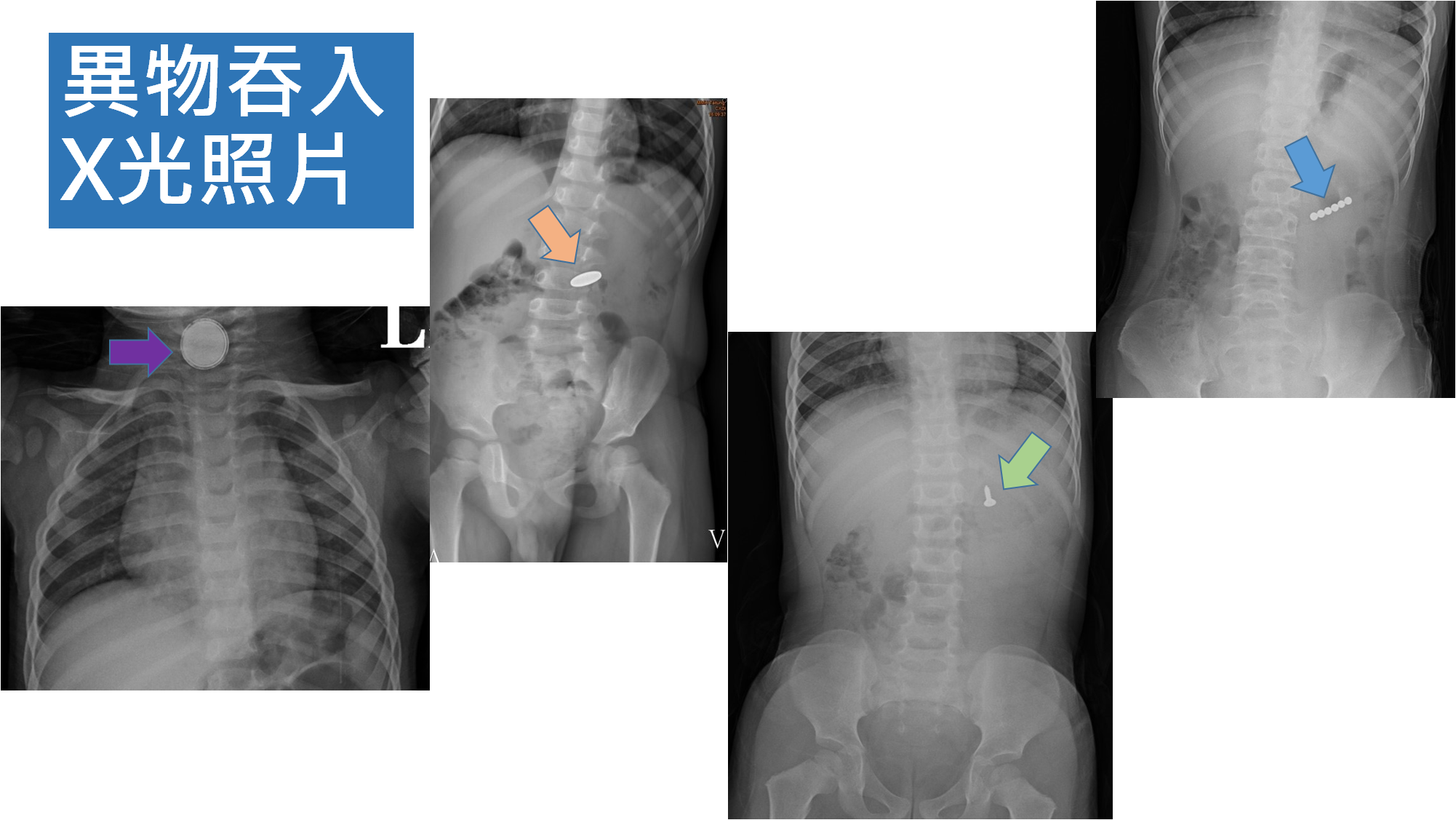 誤食的X光片。