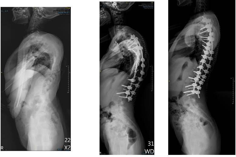 經過2次手術(中圖)為第一次、(右圖)為第二次)，脊椎角度矯正至57度。(圖/嘉義基督教醫院提供)